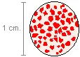 drawing of a blood smear in which the red cells have been agglutinated