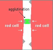 drawing of two red cells agglutinated together by an antibody connecting onto antigens on the surface of red cells