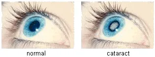 photos of a normal eye and one with a cataract